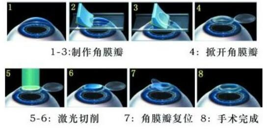 準分子激光手術(shù)到底是怎么治 愈你的眼睛的？