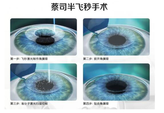 準分子激光手術(shù)到底是怎么治 愈你的眼睛的？