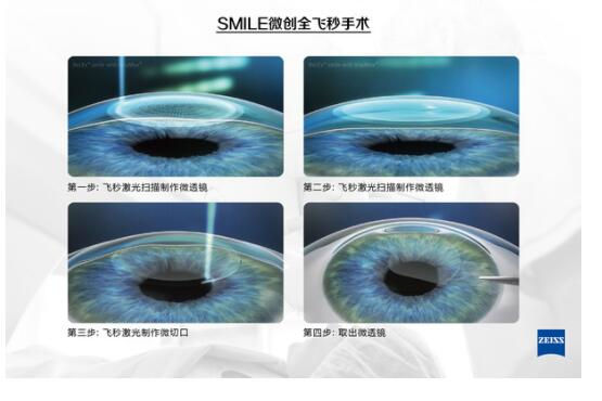 準分子激光手術(shù)到底是怎么治 愈你的眼睛的？