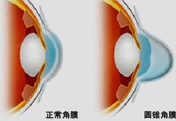 圓錐角膜，哪種角膜移植術(shù)好？