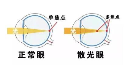 近視和散光，手術(shù)能同時(shí)矯正嗎？