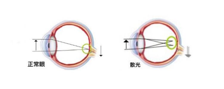 高度散光加近視可以做手術(shù)嗎？