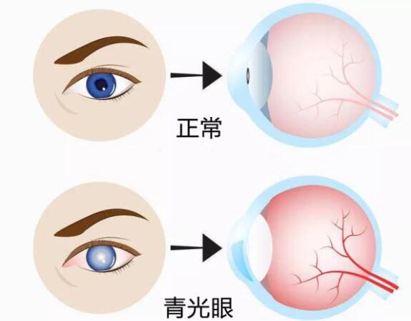 第17個青光眼周｜共管慢病青光眼，留得光明恒久遠